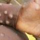 Mpox 80x80